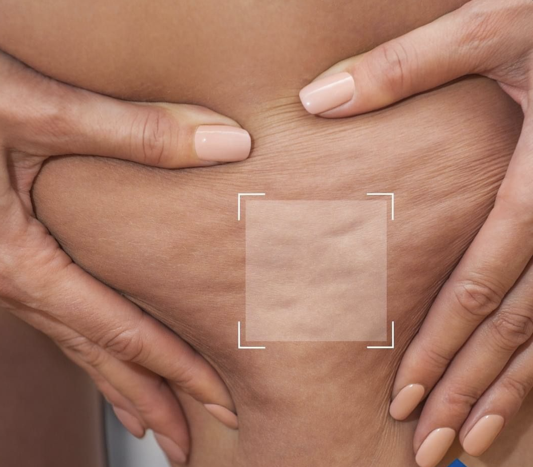 Cellulite