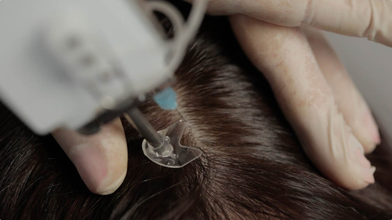 Mesotherapie Laz Esthic